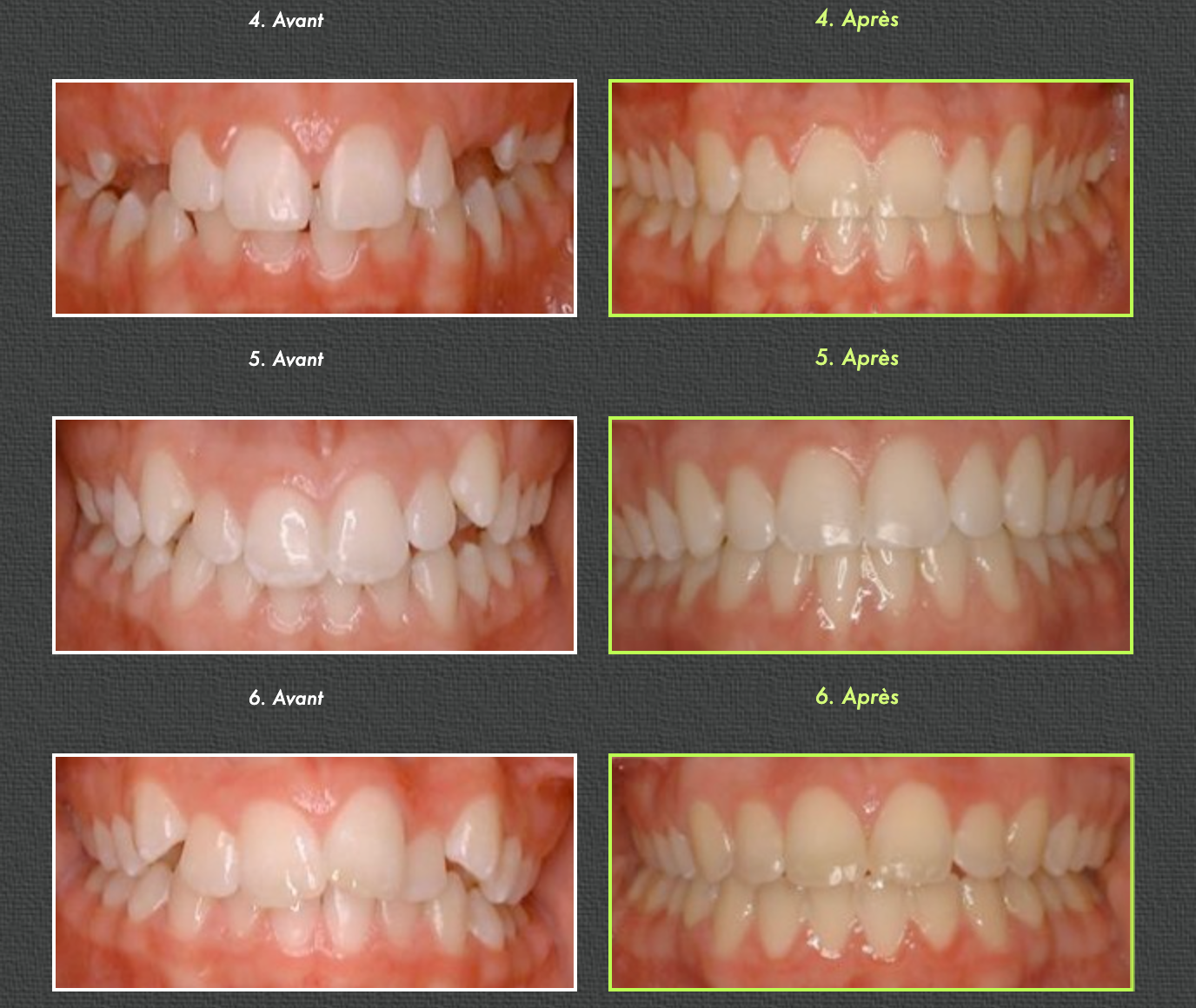 Orthodontic images: Before and after shots of teeth alignment, showing improvement.