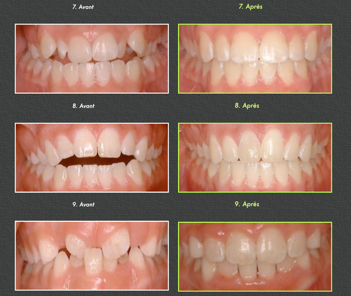 Before and after photos of teeth alignment, rows of smiling mouths.
