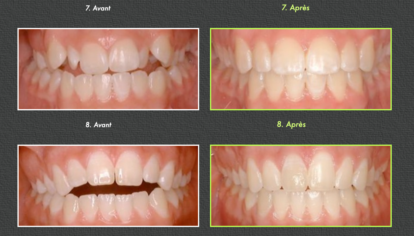 Before and after photos of teeth alignment, rows of smiling mouths.