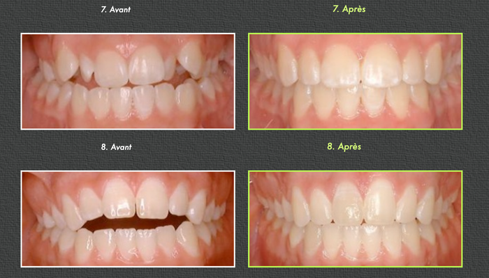 Before and after photos of teeth alignment, rows of smiling mouths.
