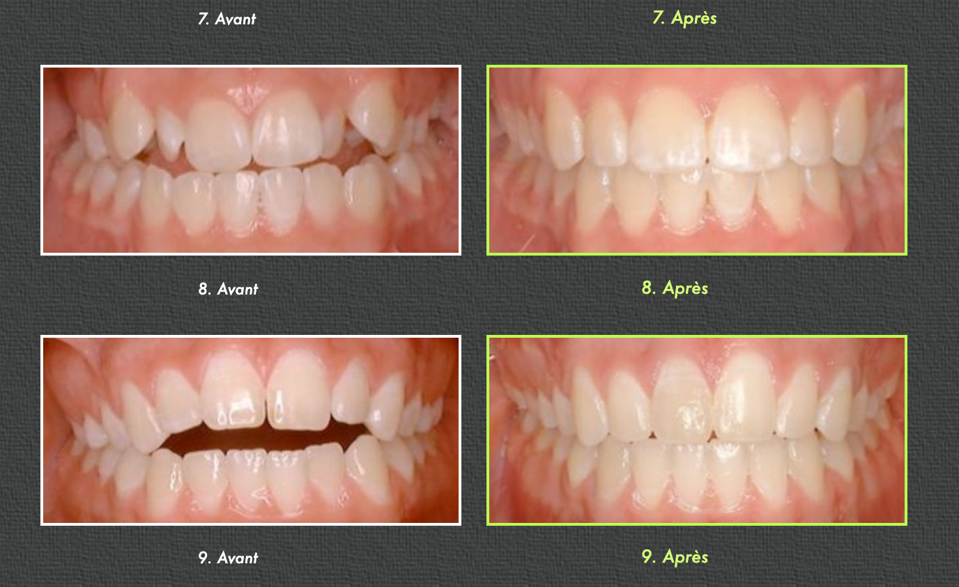 Before and after photos of teeth alignment, rows of smiling mouths.