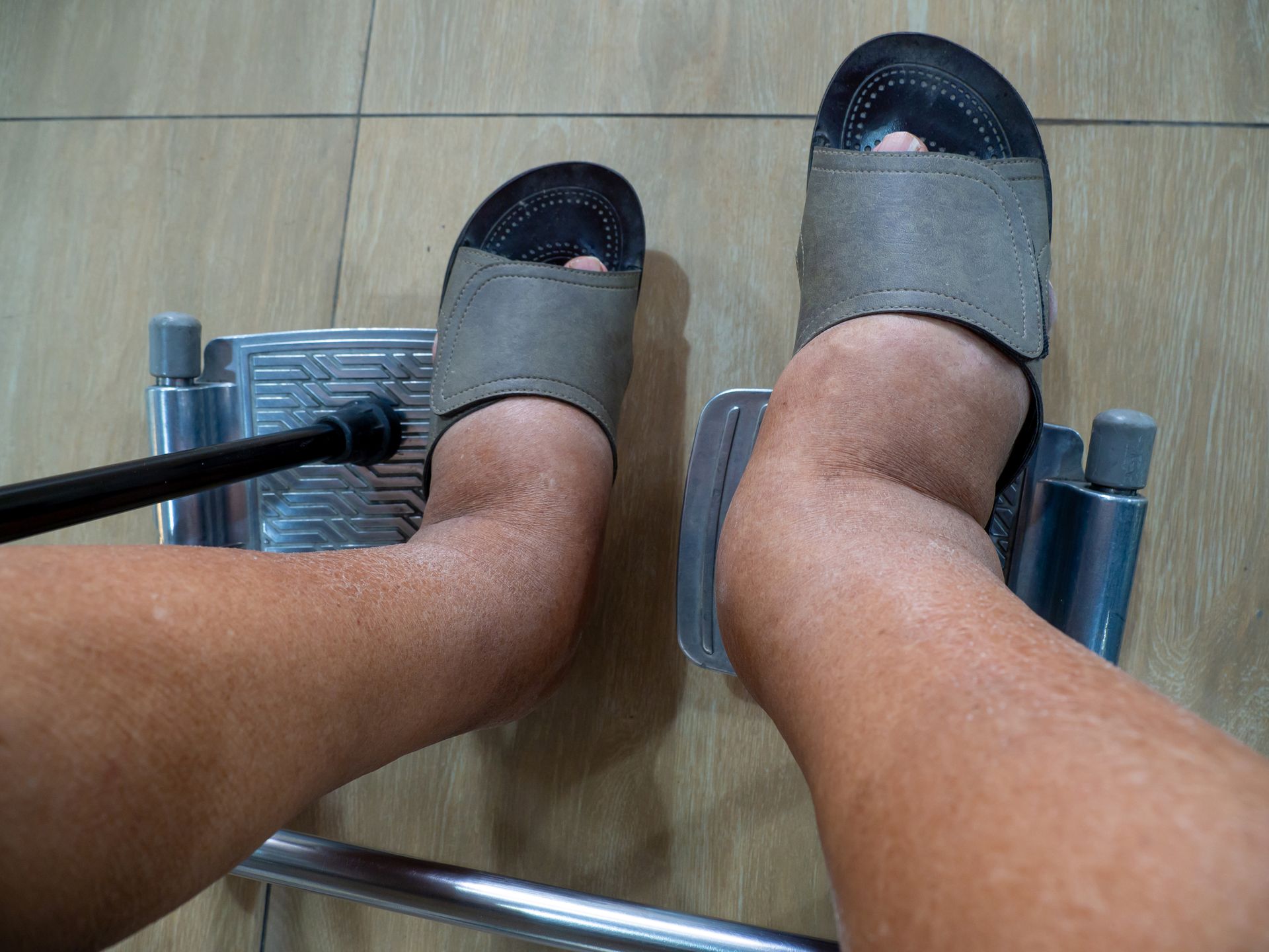 A partial view of a patient seated in a wheelchair with swollen feet in slippers.