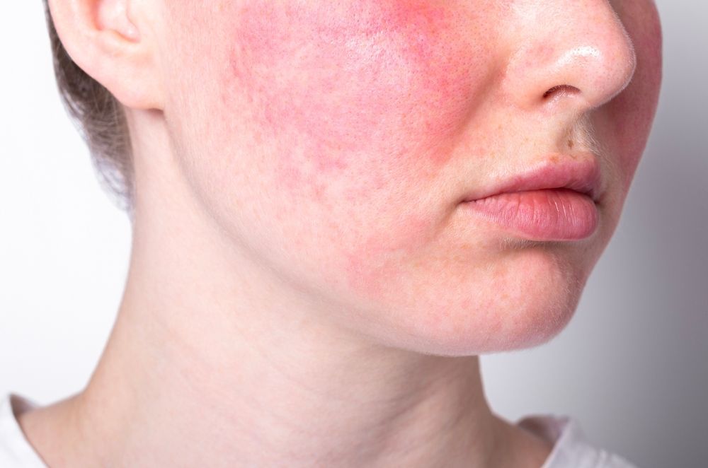 Close-up of a person's face with red, irritated skin on the cheeks and jawline.