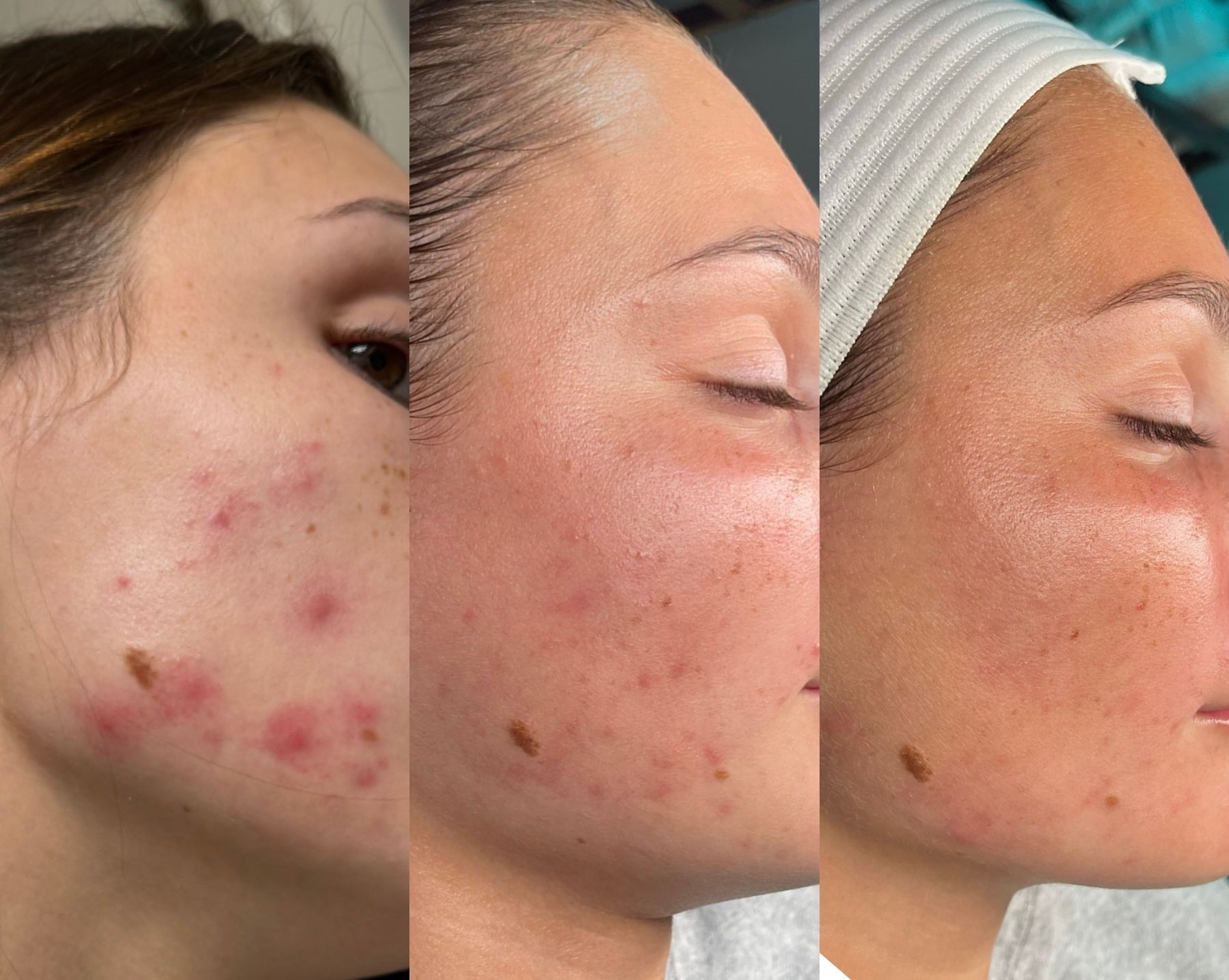 A before and after photo of a woman 's face with acne.