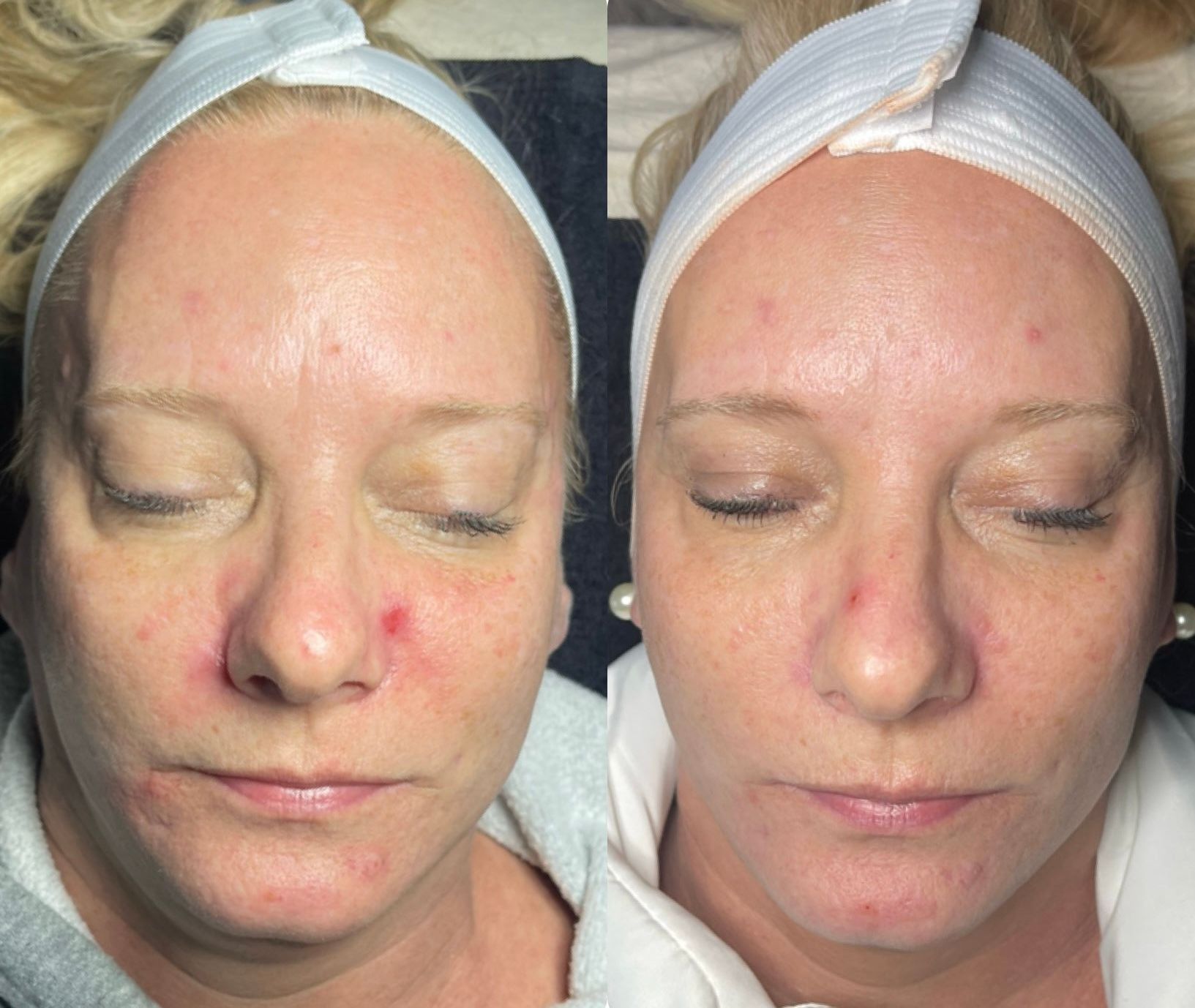 A before and after photo of a woman 's face with acne.