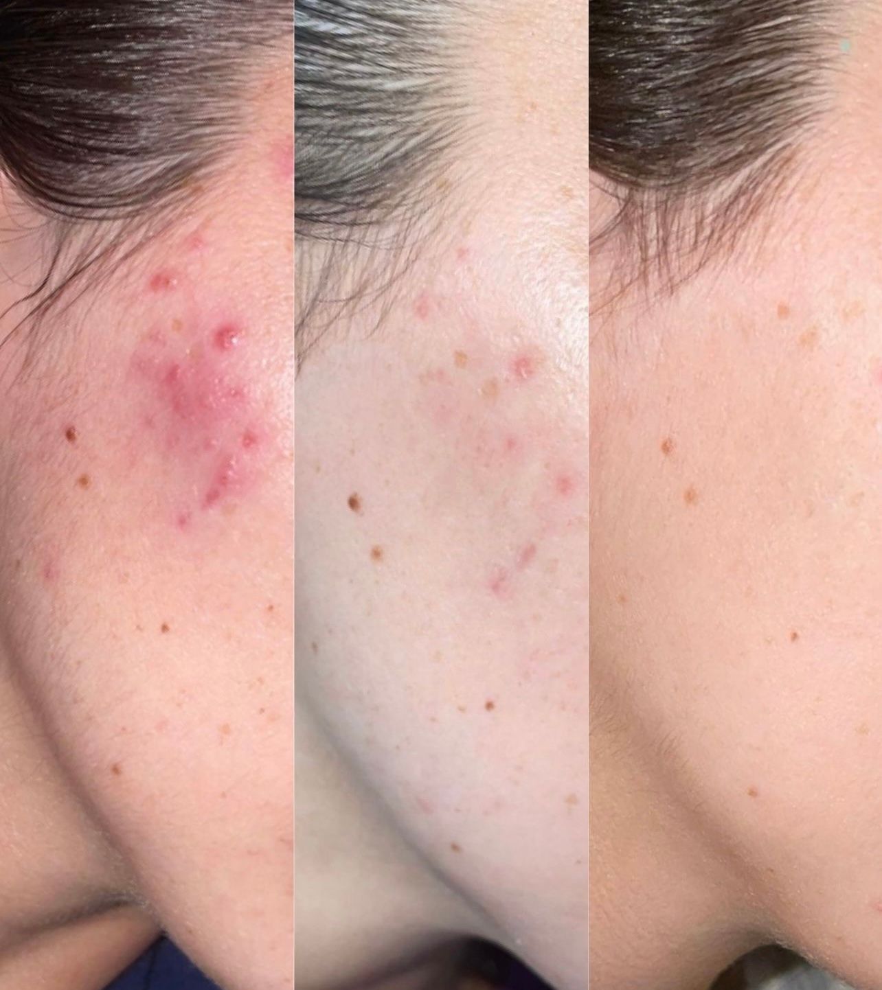 A before and after picture of a woman 's face with acne.