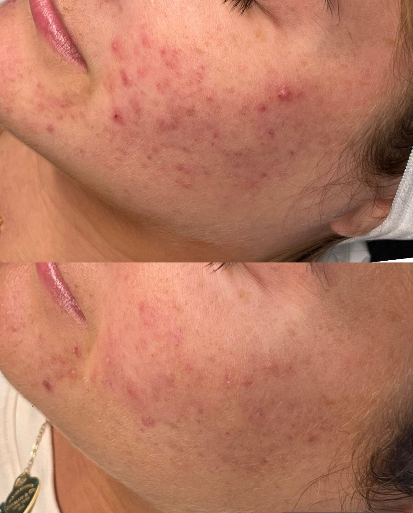 A before and after photo of a woman 's face with acne.