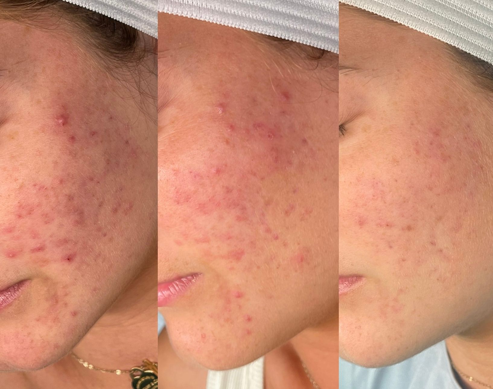 A woman 's face with acne before and after treatment.