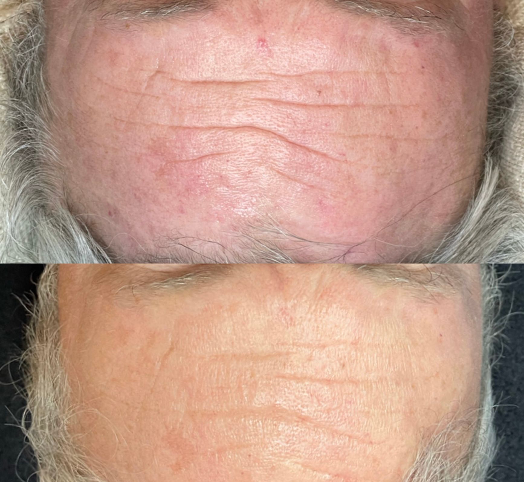 A before and after photo of a man 's face with wrinkles.