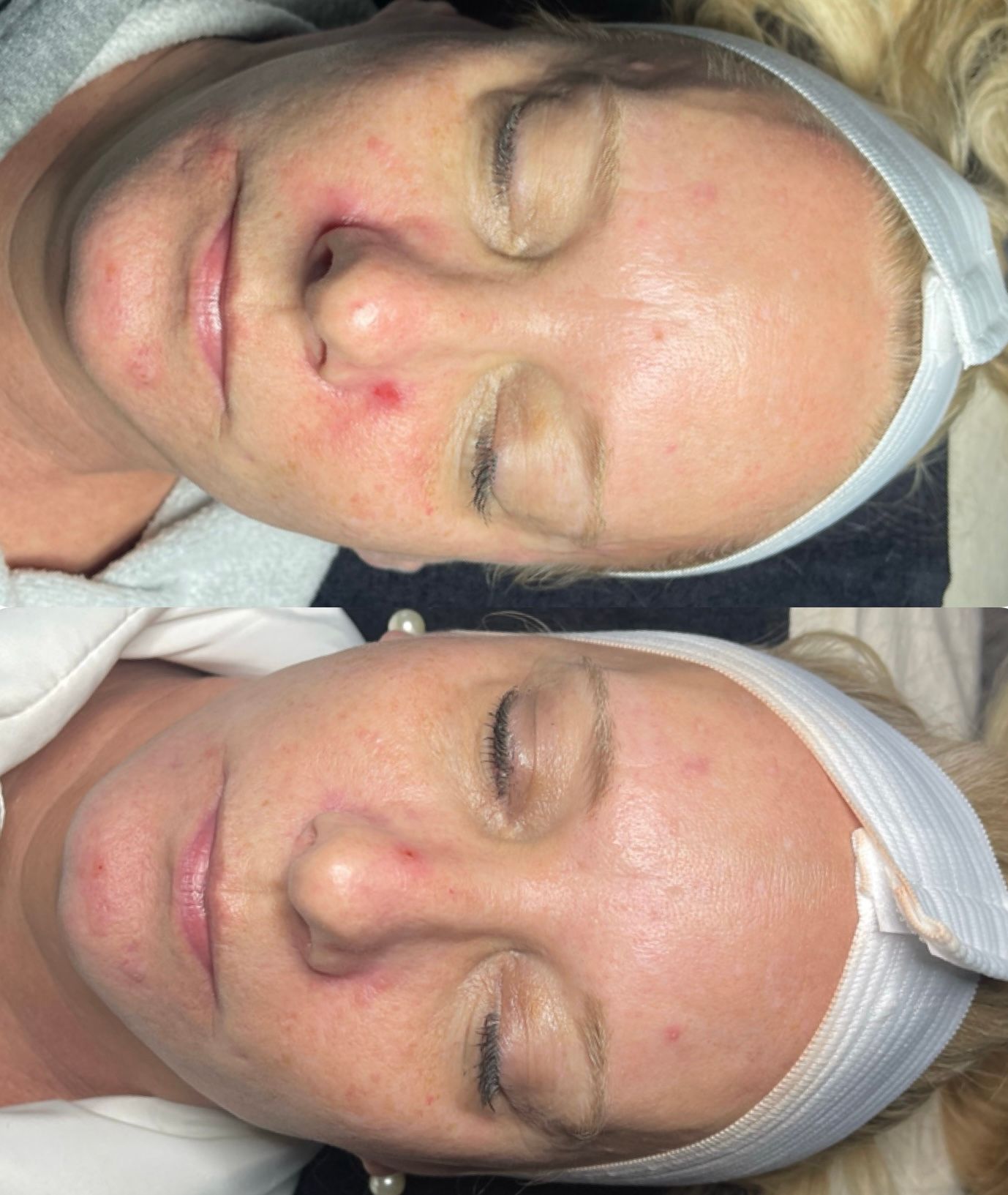 A before and after photo of a woman 's face with acne.