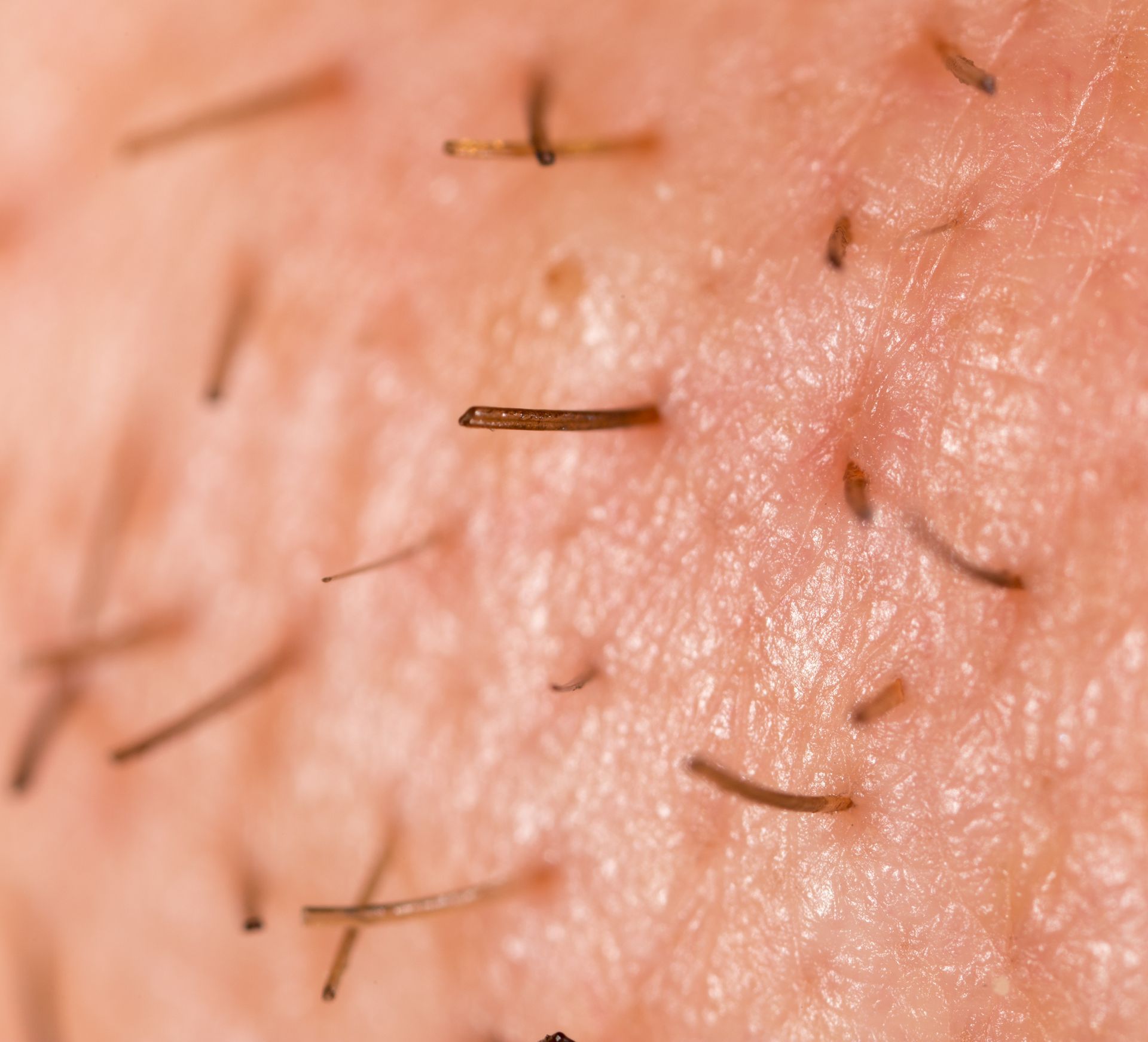 Close-up of human skin with many short, dark hairs protruding.