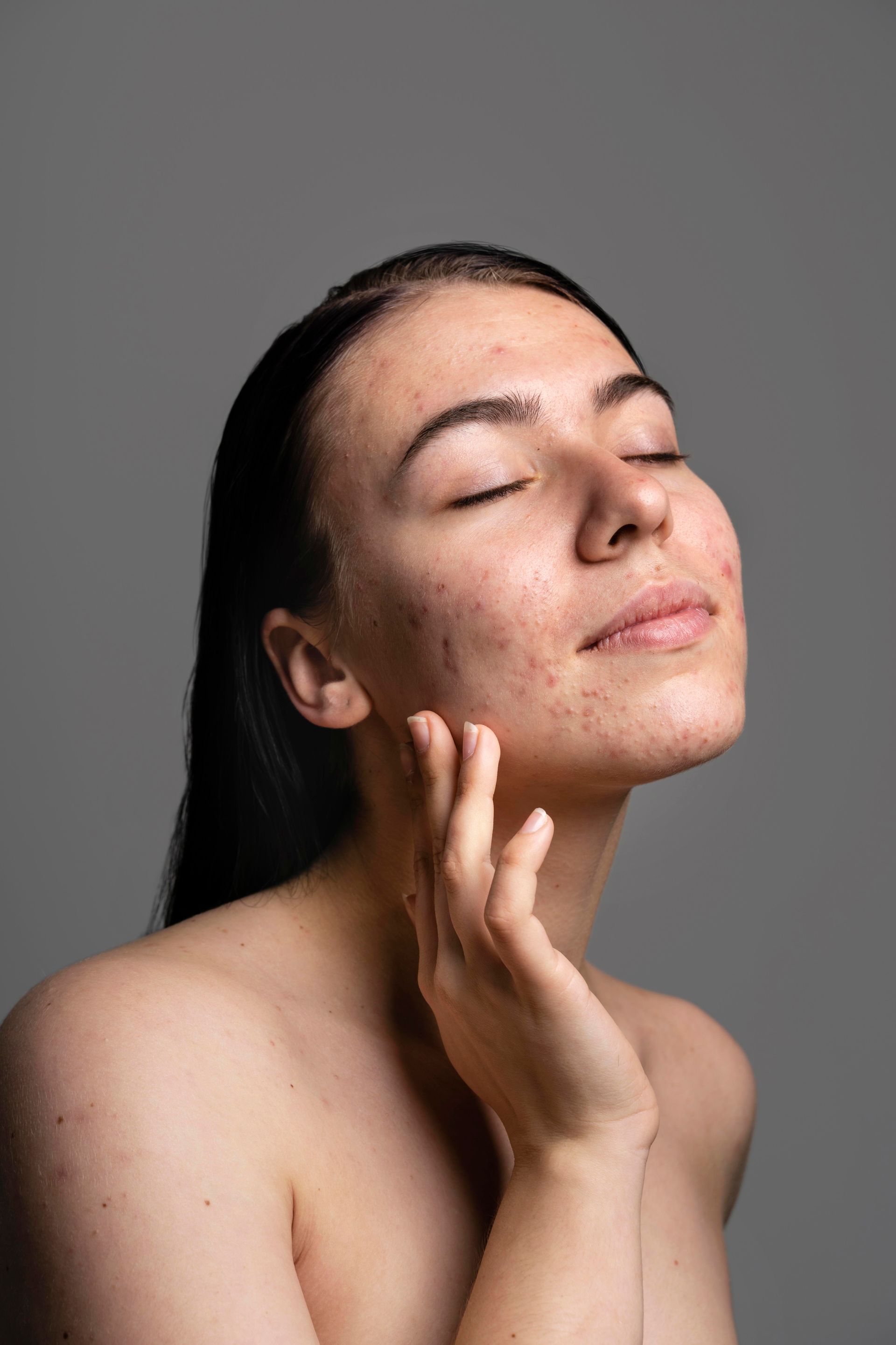 Woman with eyes closed and acne on her face