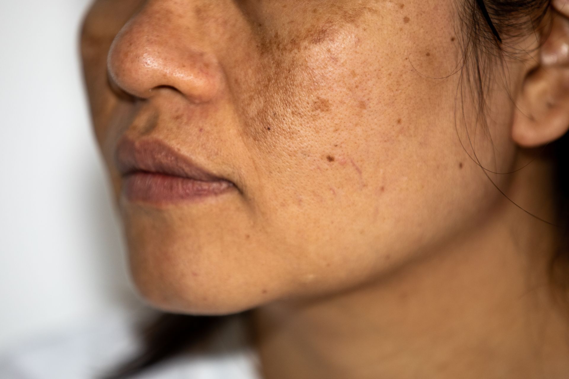 Close-up of a person's face showing skin discoloration and uneven pigmentation on cheeks, nose, and forehead.