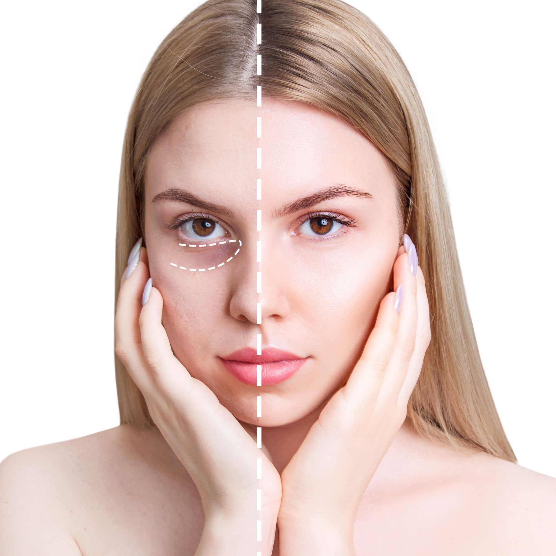 Woman's face: one side with dark under-eye circles, other side smooth. Hands on cheeks, white background.
