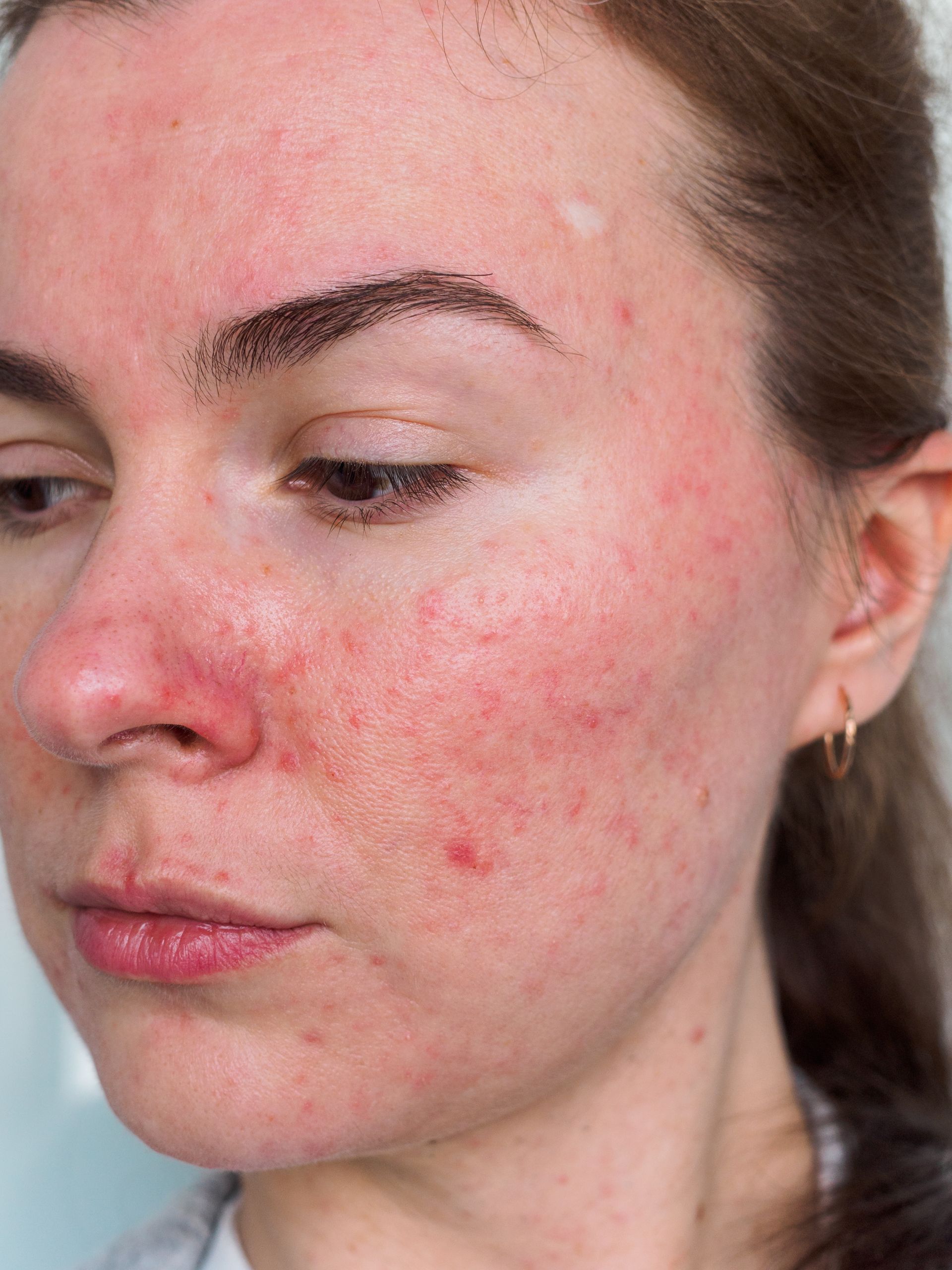 Woman's face with widespread facial redness and small, red bumps, possibly indicating a skin condition.