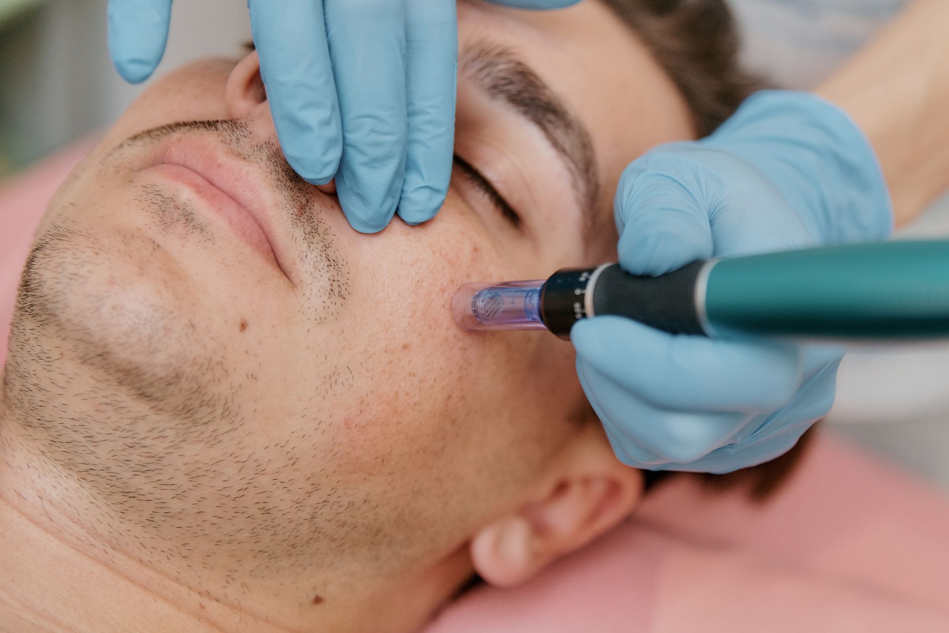 A man is getting a microneedle treatment on his face.