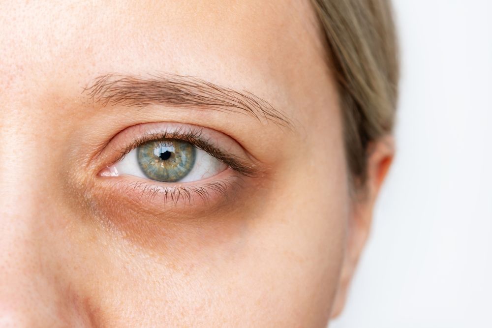 A close up of a woman 's eye with dark circles.