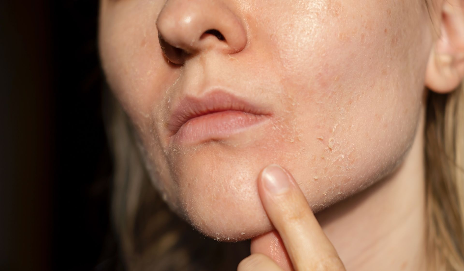 Person with dry, flaking skin around the mouth and chin, pointing to the affected area.