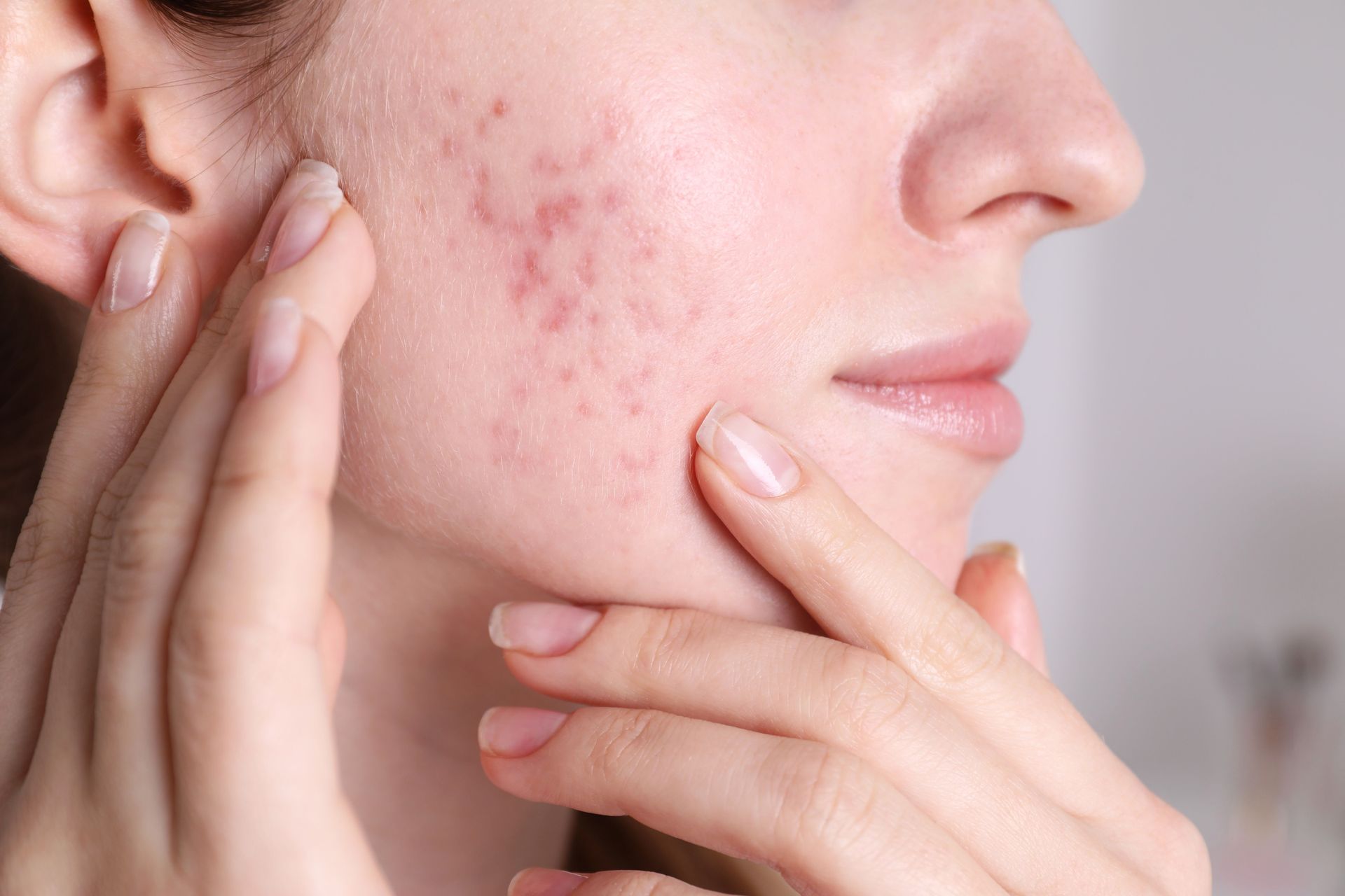 Woman's face with acne, touching cheek. Red, inflamed blemishes present.