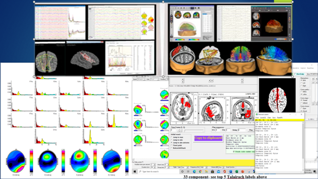 Quantitative Electroencephalography (qEEG)