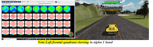 Neurofeedback