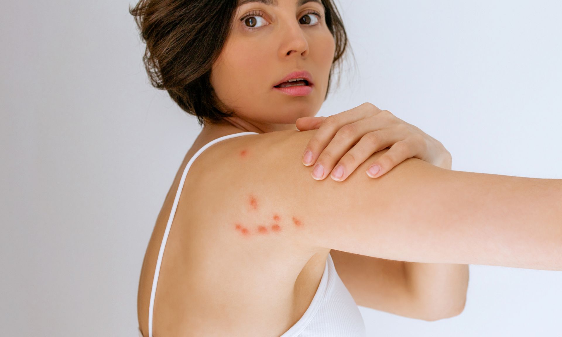 A woman scratches her shoulder bitten by a bedbug. A woman scratches her shoulder bitten by a bedbug.