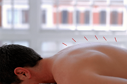 Acupuncture Needles - Family Medicine in Greenville, NC