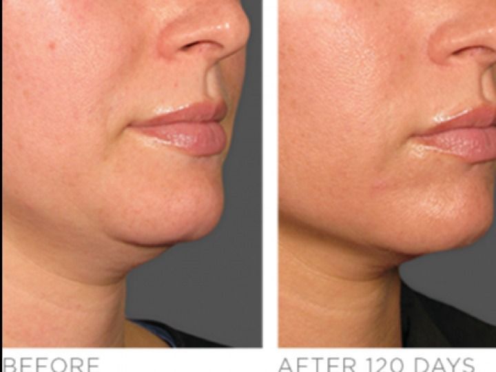A before and after photo of a woman 's face