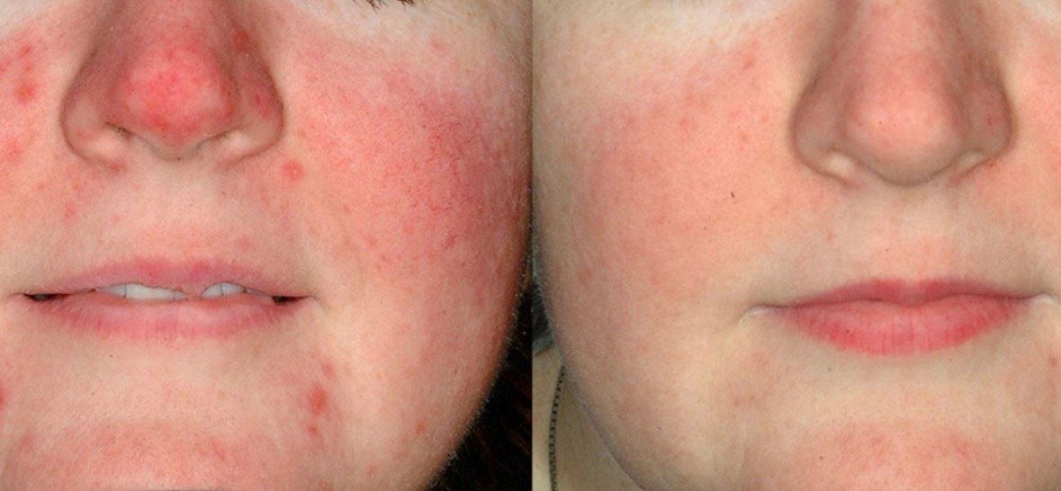 A woman is getting a laser treatment on her face.