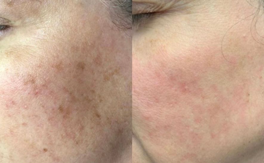 A woman is getting a laser treatment on her face.