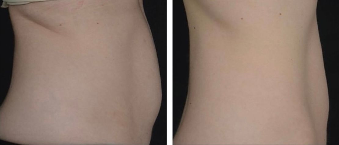 A woman is getting a laser treatment on her face.