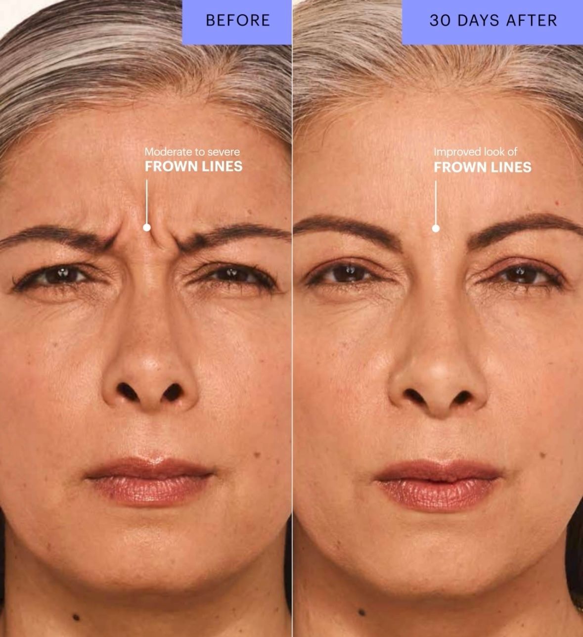 A woman is getting a laser treatment on her face.