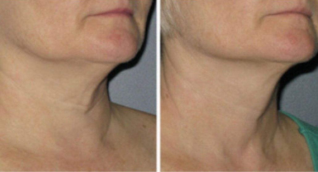 A woman is getting a laser treatment on her face.