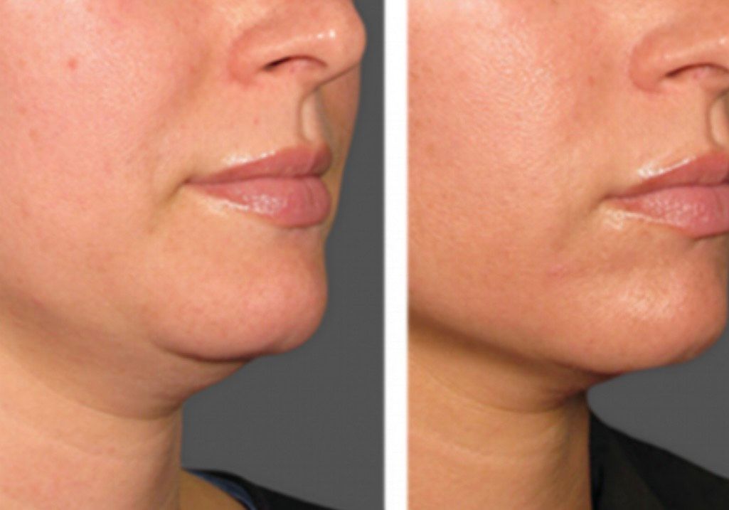A woman is getting a laser treatment on her face.