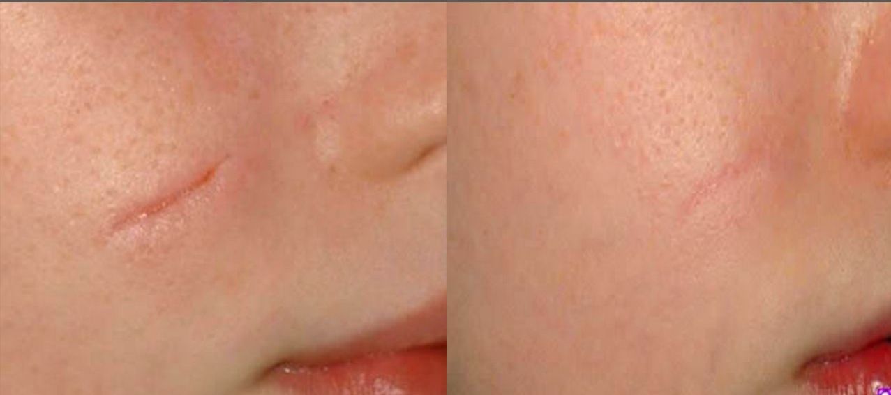 A woman is getting a laser treatment on her face.