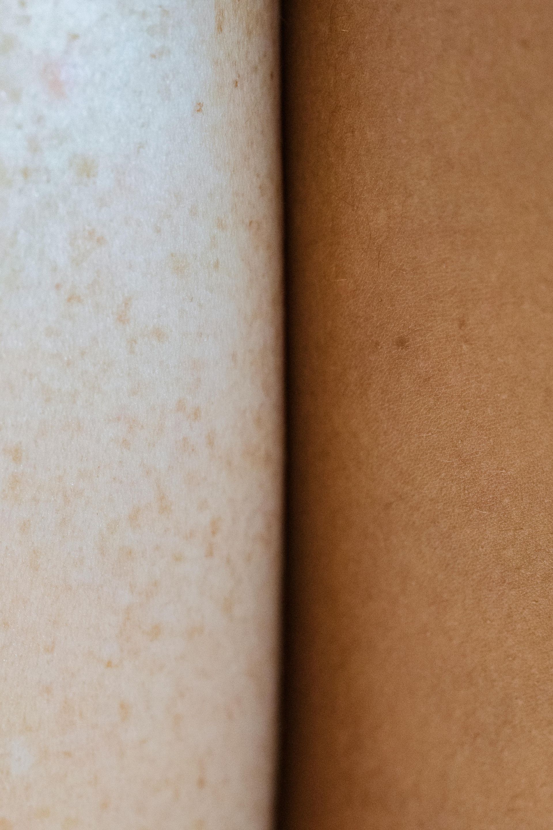 A close up of a person 's leg with freckles and a close up of a person 's leg with no freckles.