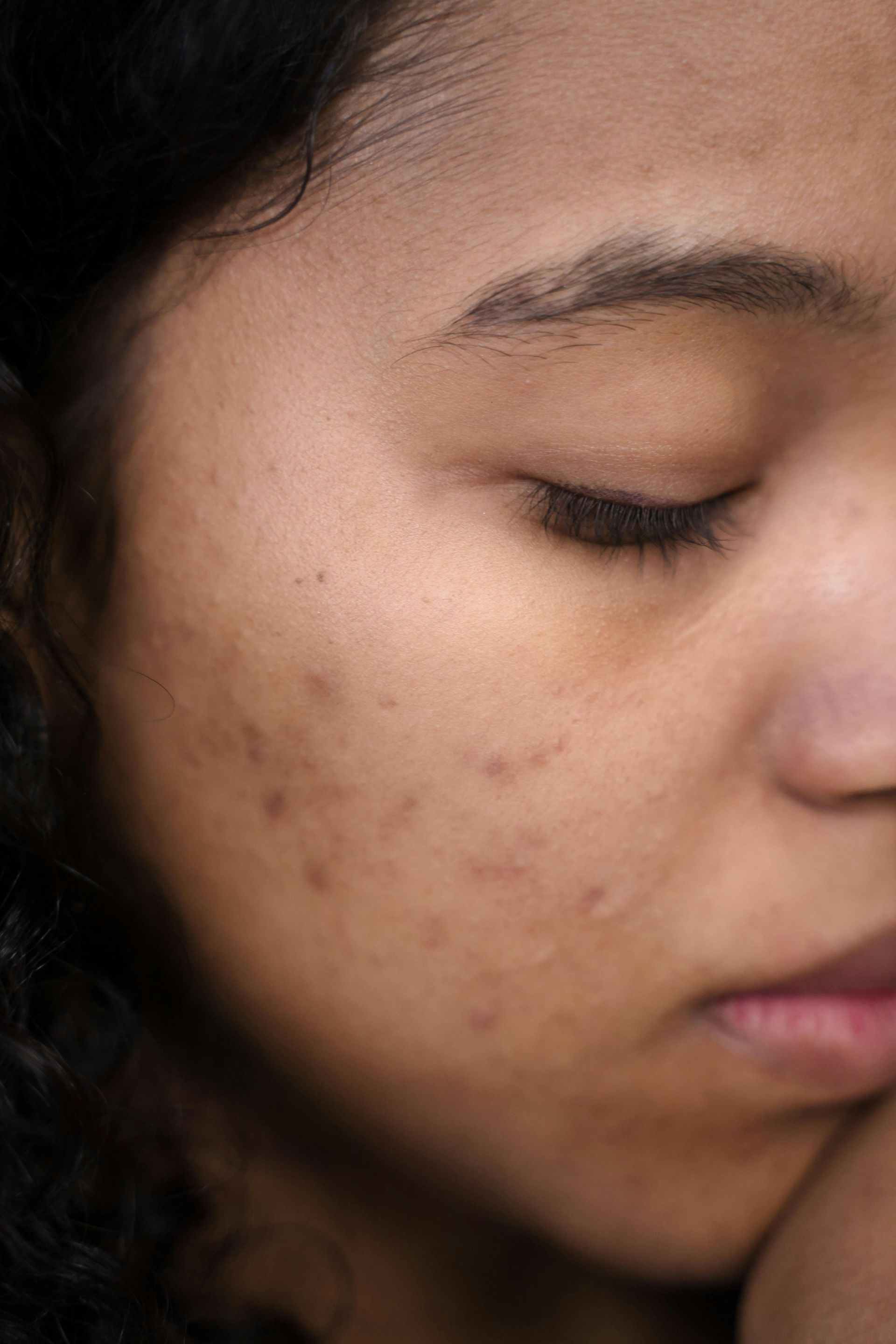 A close up of a woman 's face with acne on it.