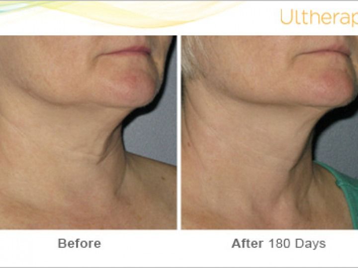 A before and after photo of a woman 's neck with the words ultherac on the bottom