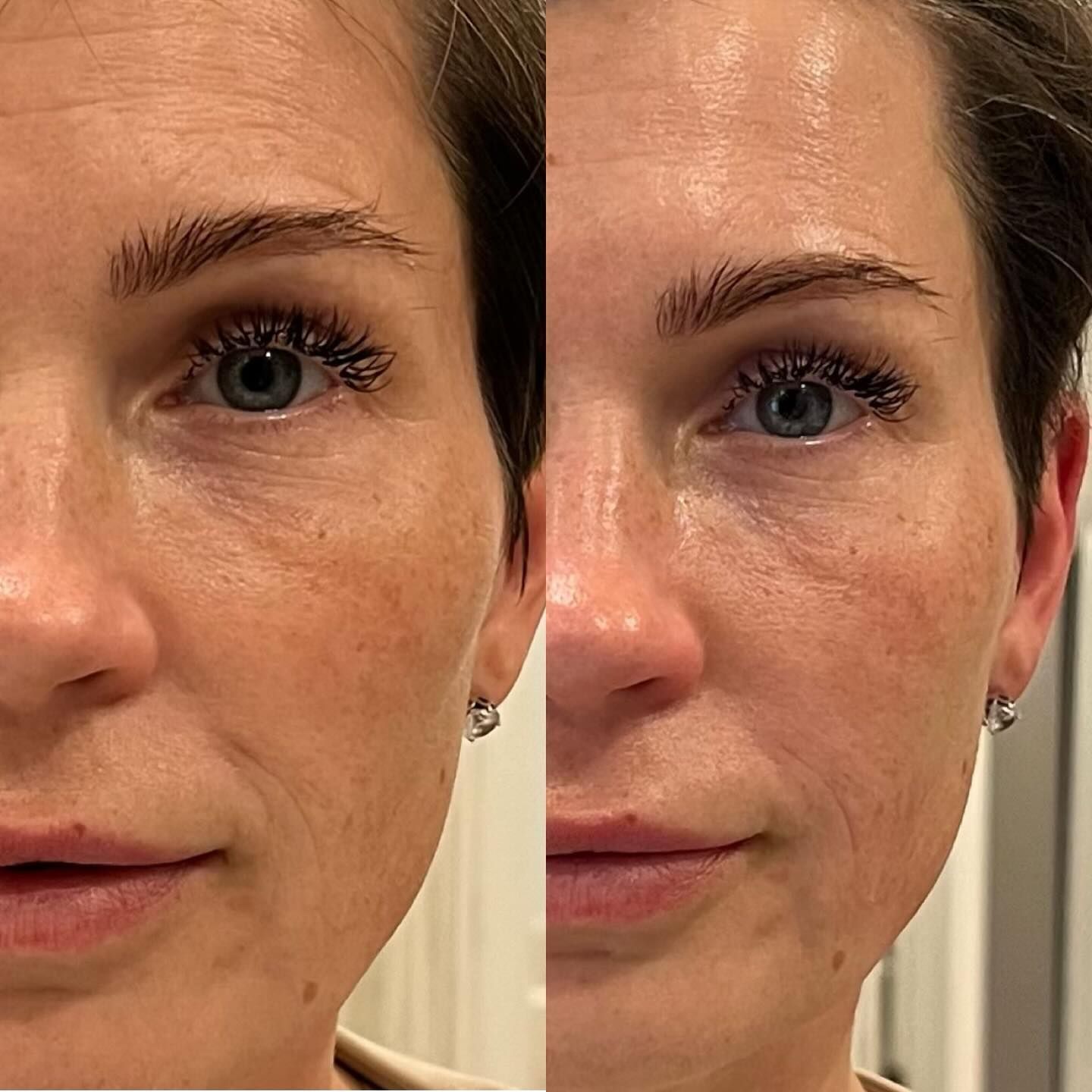 Side-by-side view of a face before and after treatment, showing reduction in wrinkles and improved skin tone.