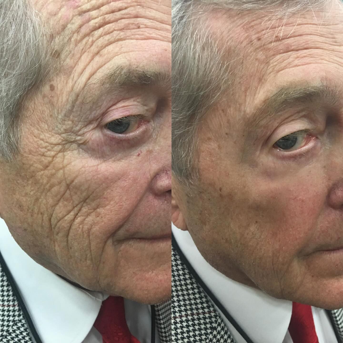 Comparison of a man's face: left side shows wrinkles, right side appears smoother, possibly due to a skin treatment.