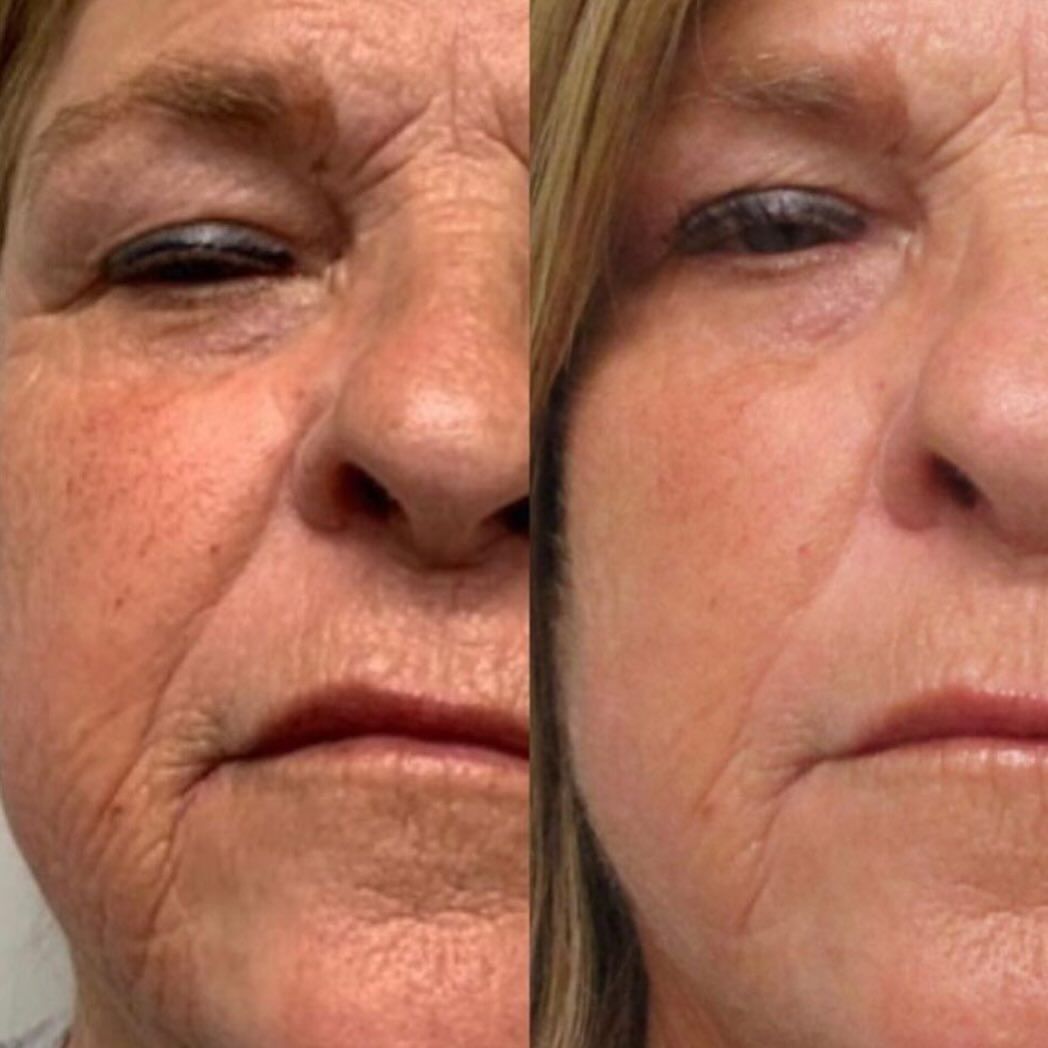 Side-by-side comparison of a person's face showing wrinkled skin on the left and smoother skin on the right.