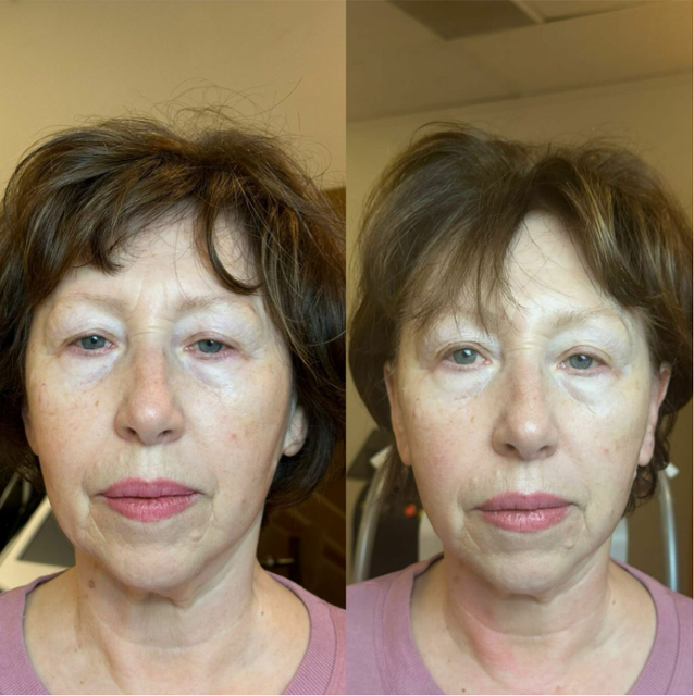 Before and after facial photo: woman with slightly fuller face and less prominent wrinkles.