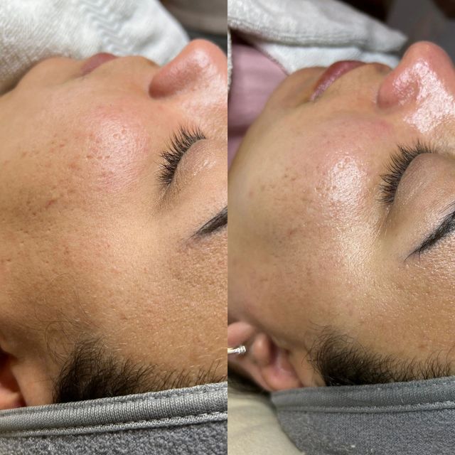 Two close-up photos side by side: before and after facial treatment, showing skin texture and reduced pore size.