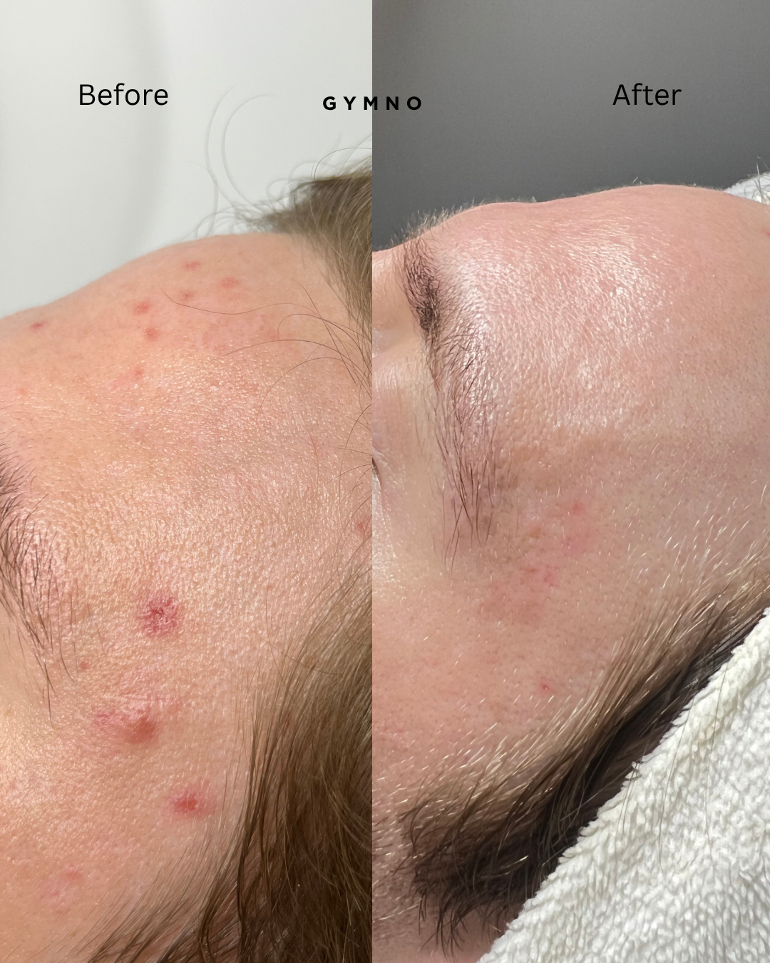 acne treatment results