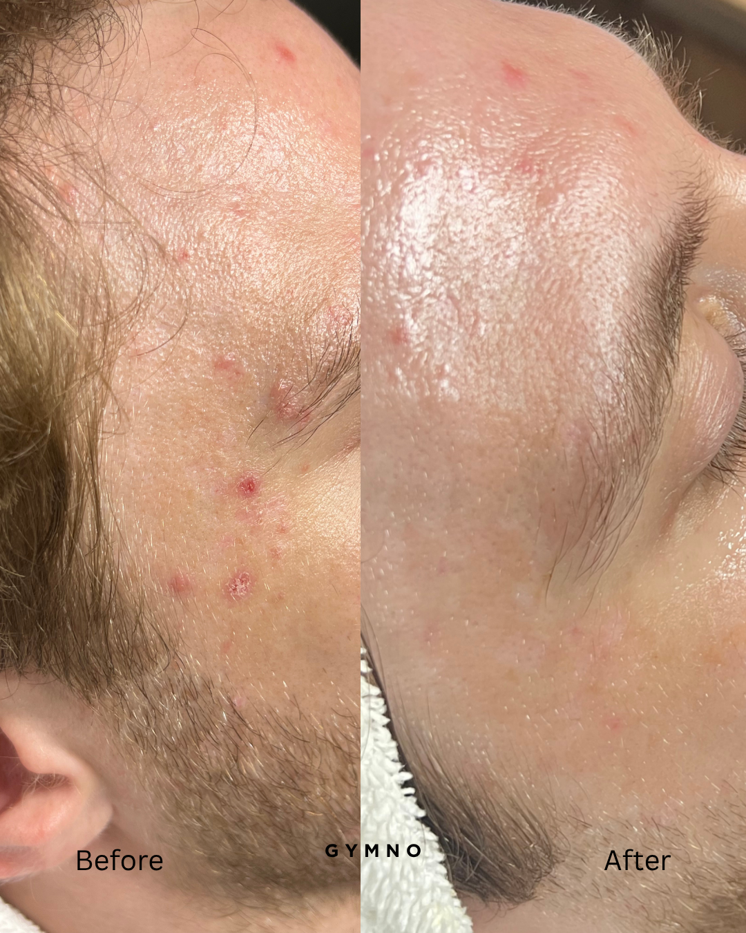 acne treatment results