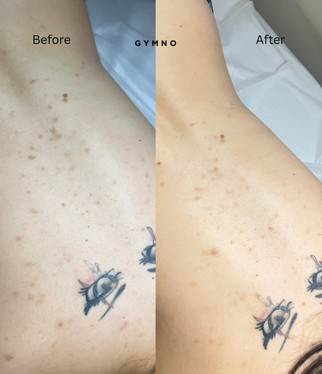 hyperpigmentation treatment results
