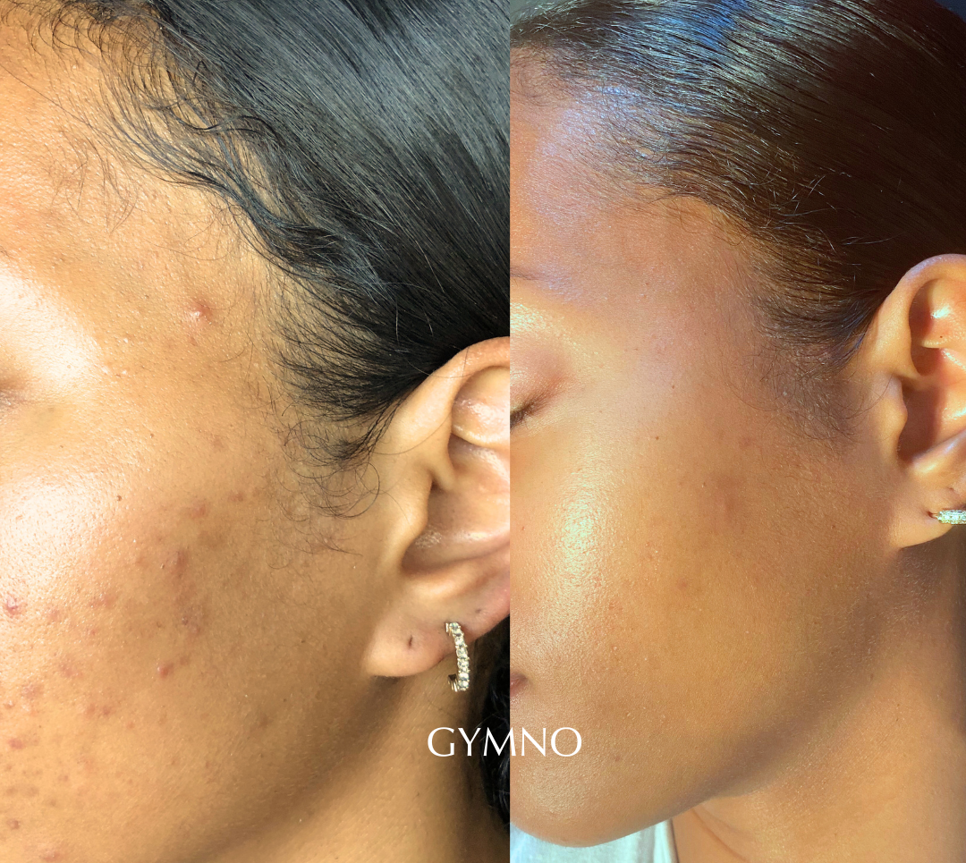 acne treatment results