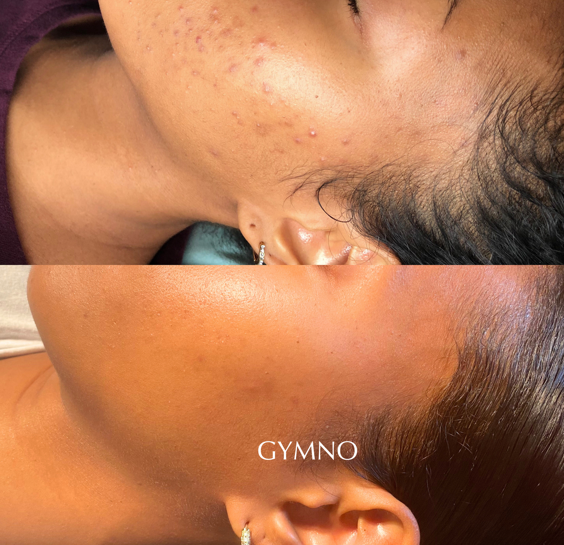 acne before and after