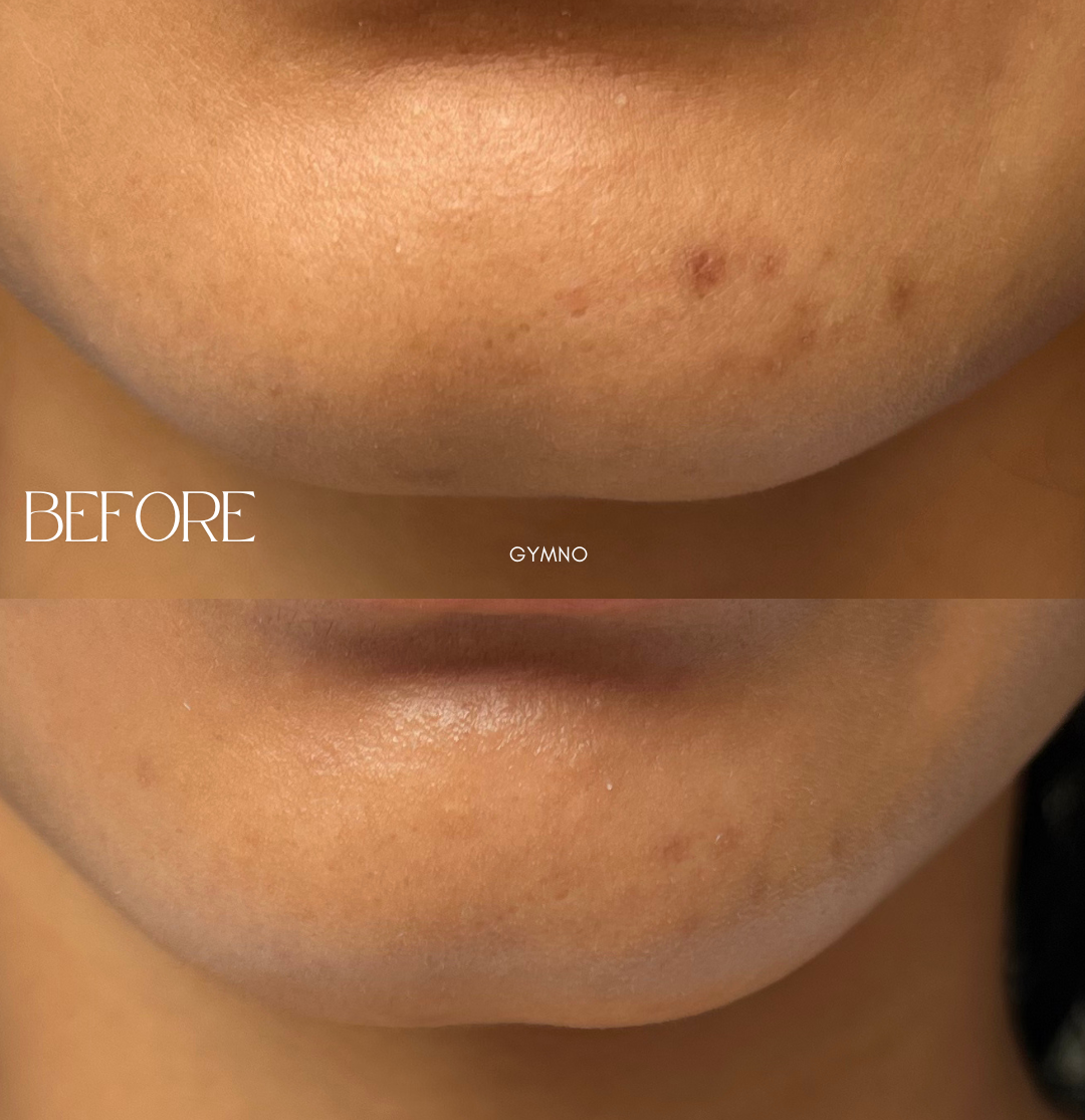 hyperpigmentation treatment results