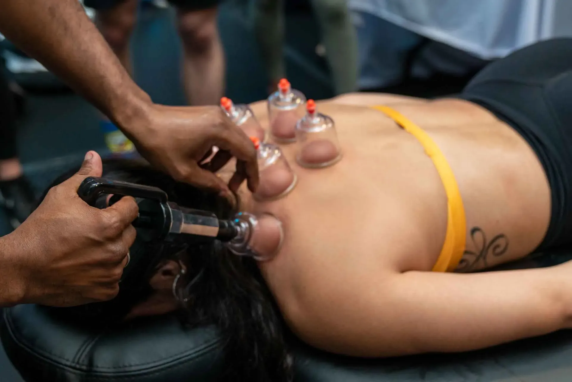 A woman is laying on a table getting cupping treatment on her back.